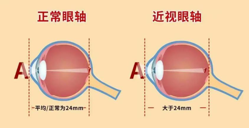 高度近视，可能没你想的那么简单！
