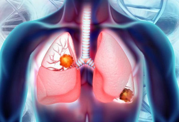 5年生存率仅2%的小细胞肺癌，重磅新疗法值得期待