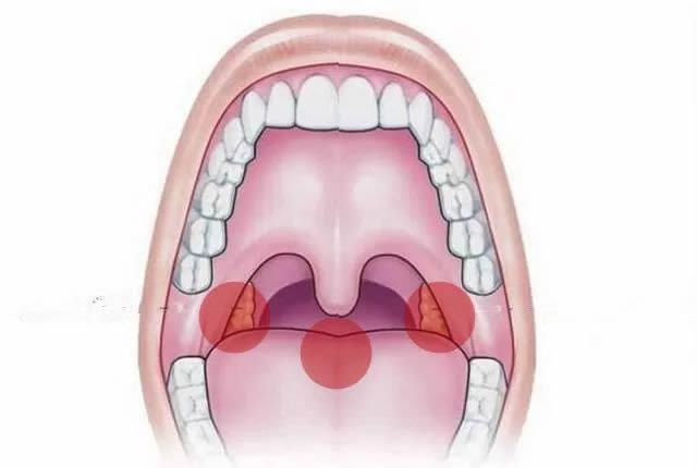 喉咙壁图片