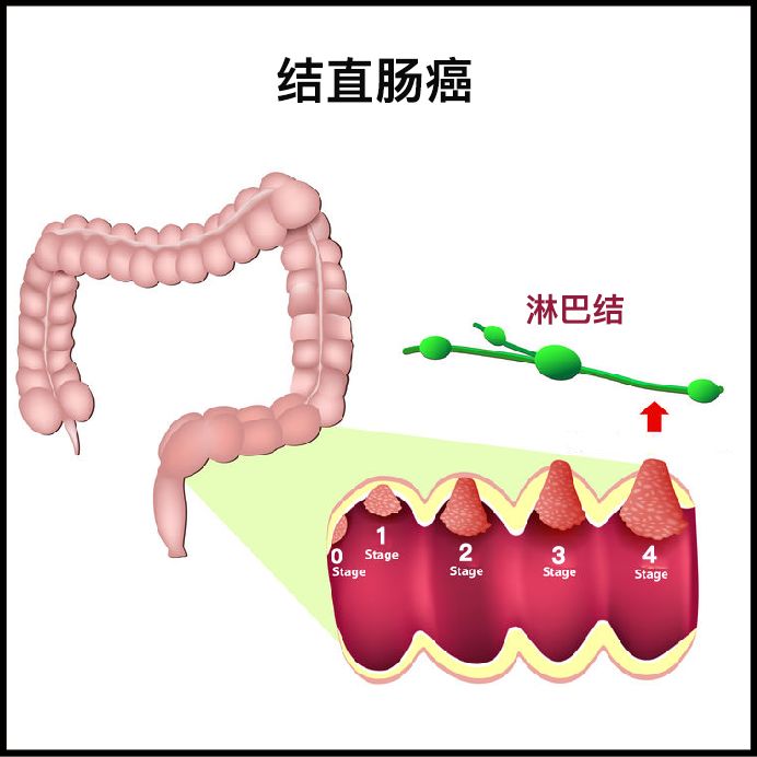 结直肠癌