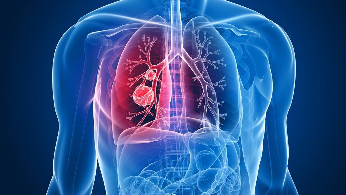 《非小细胞肺癌EGFR 20号外显子插入突变检测临床实践中国专家共识（2024版）》发布！【内附下载】