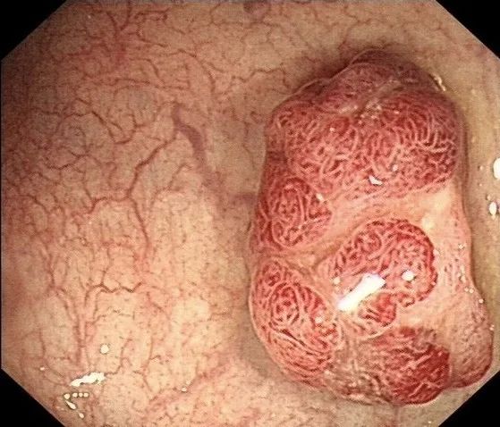 从6mm的小息肉，发展成肠癌，需要几年？