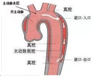 超全汇总！主动脉夹层的超声诊断要点